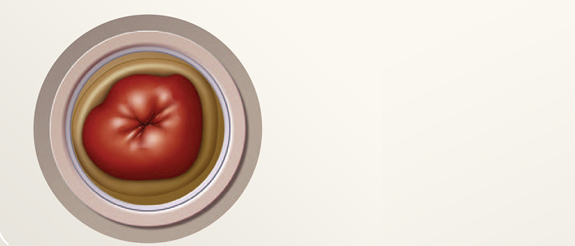 En illustrasjon av en stomi