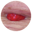 Soft or Flaccid Abdomen
