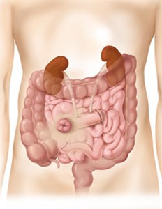 urostomy