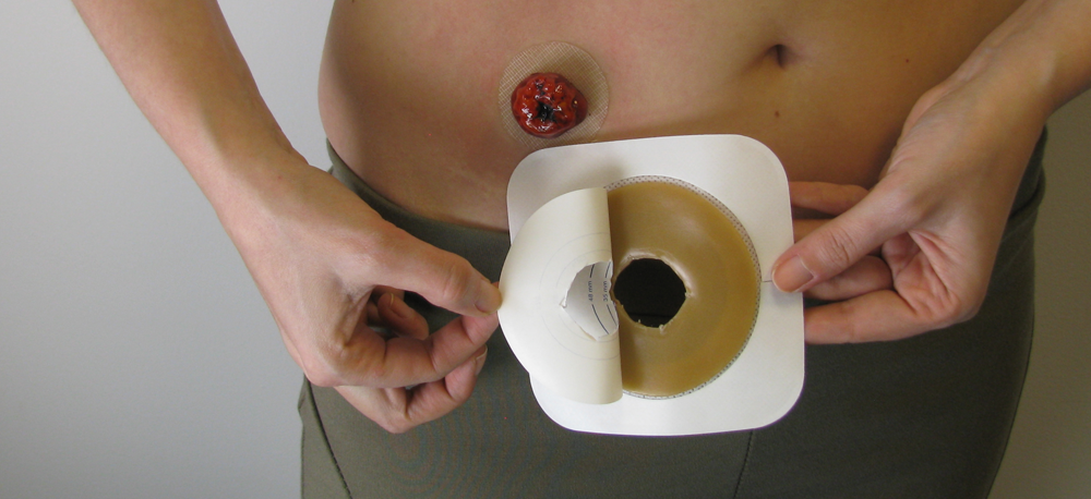 ConvaTec Esteem Synergy Versorgungswechsel Schritt f&uuml;r Schritt 04