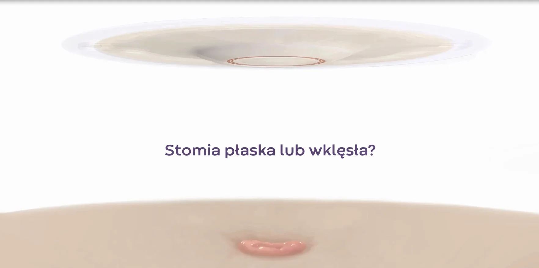 Film wyjaśniający zrównanie lub cofnięcie stomii oraz umiejscowienie naprężenia w celu wysunięcia stomii w pielęgnacji stomii.