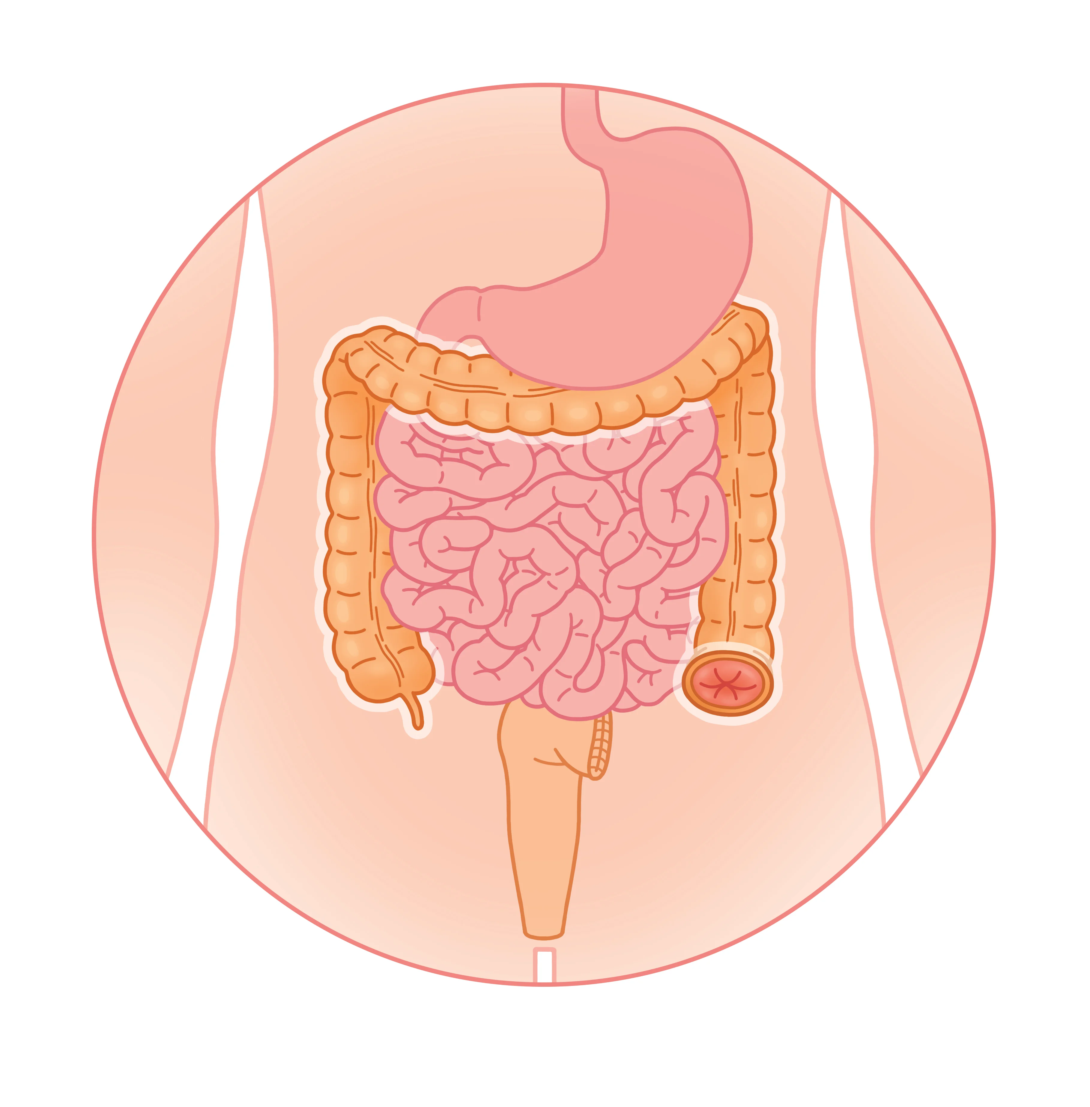 Chirurgie de colostomie