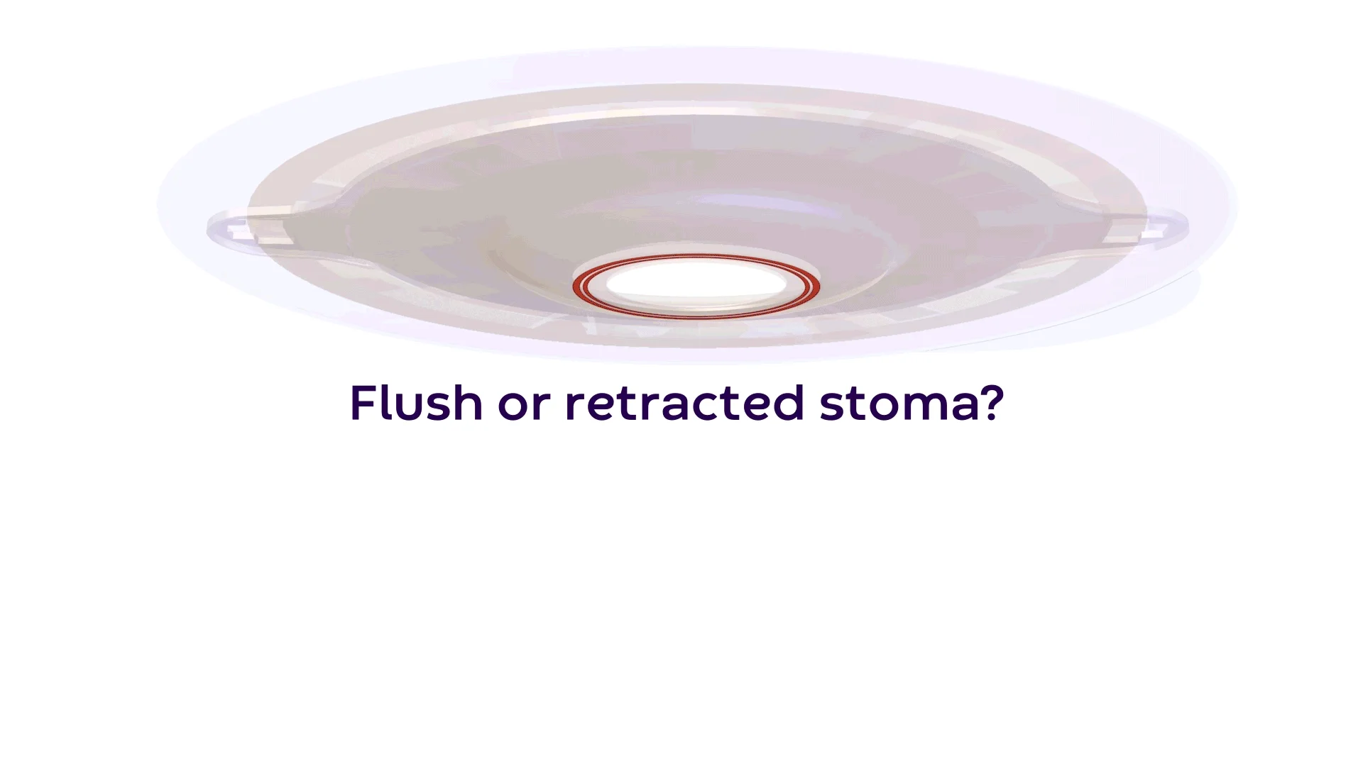 A video explaining flush or retracted stoma and tension placement for protrusion in ostomy care.