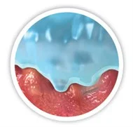 傷口床的微輪廓圖